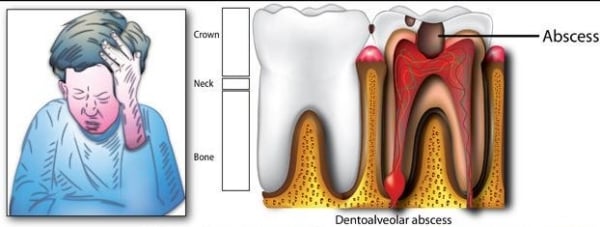Ursachen Zahnschmerzen-karies Bildung-Nerven Entzündung Zahnfleisch