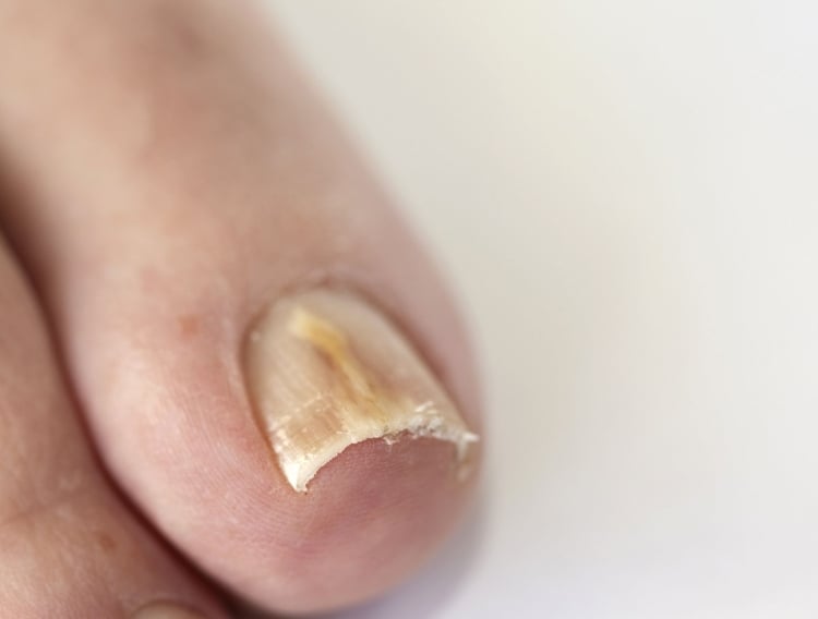 Fußpilz an den Zehennägeln dicke-gelbe-nagel