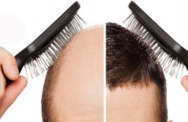 Haartransplantation-haare-glatze-haltbarkeit-ergebnisse