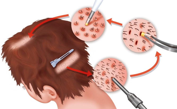 Haartransplantation-methode-technik-preise-ergebnisse