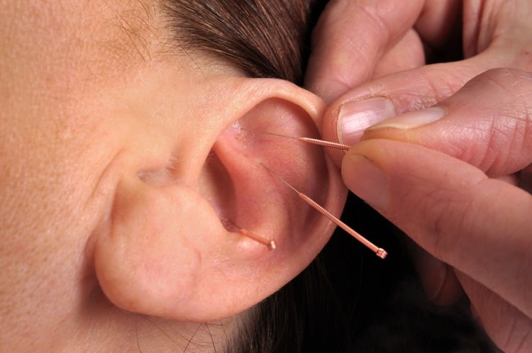 Abnehmen mit Akupunktur im Ohr Nadeln