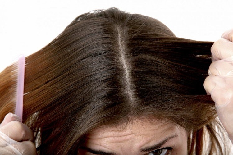 Hausmittel gegen Schuppen juckende Kopfhaut fettige Haare