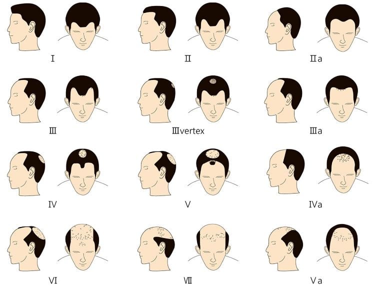 frisuren mit geheimratsecken für männer haarschnitt haaransatz verdecken nordwoood klassifikation
