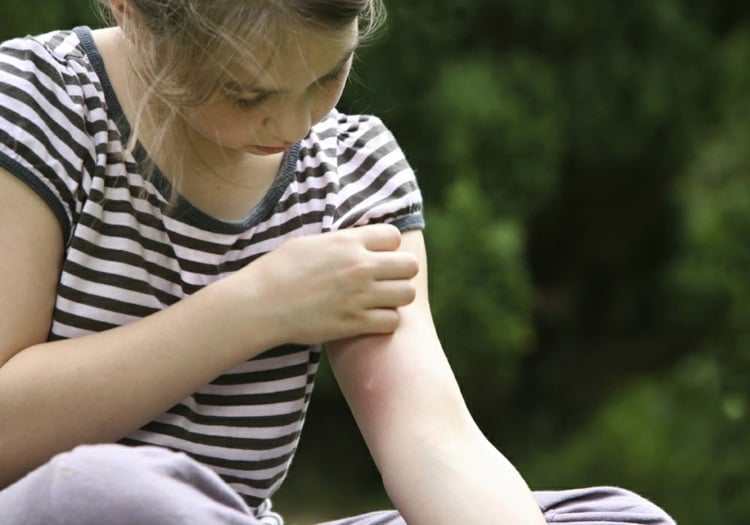 hausmittel mückenschutz mückenstiche juckreiz symptome