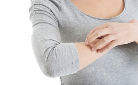 Allergie gegen Mückenstiche juckende Haut am Arm Entzündung