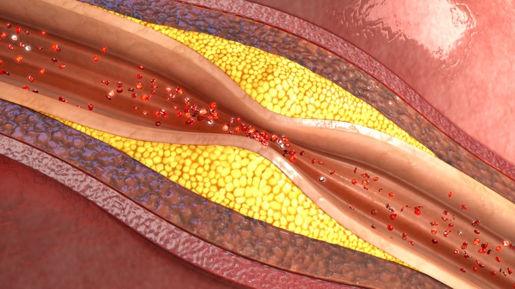 Atherosklerose die Ansammlung von Ablagerungen an der Innenwand der Blutgefäße
