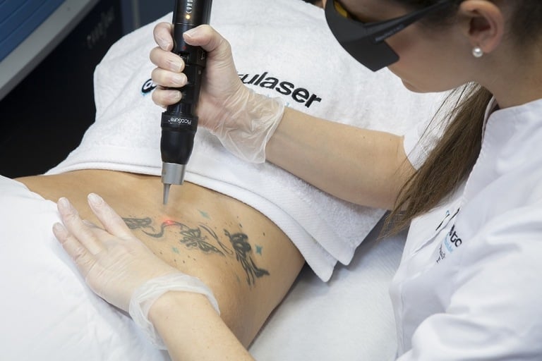 Tattoo entfernen Kosten Tattooentfernen Operation Kosten