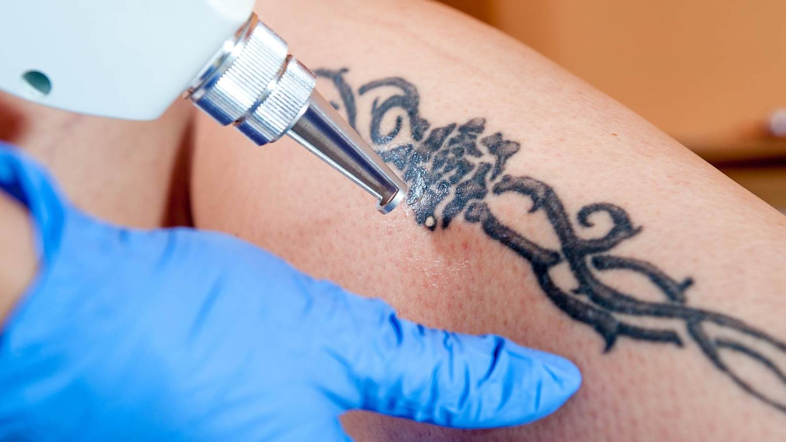 Tattoo entfernen Laser Tattooentfernung Schmerzen Kosten