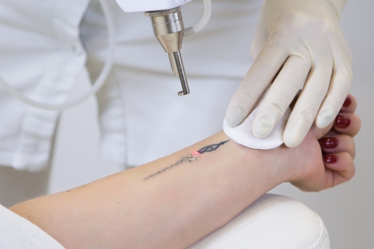Tattoo entfernen Methoden Laser Tattooentfernung Kosten Schmerzen