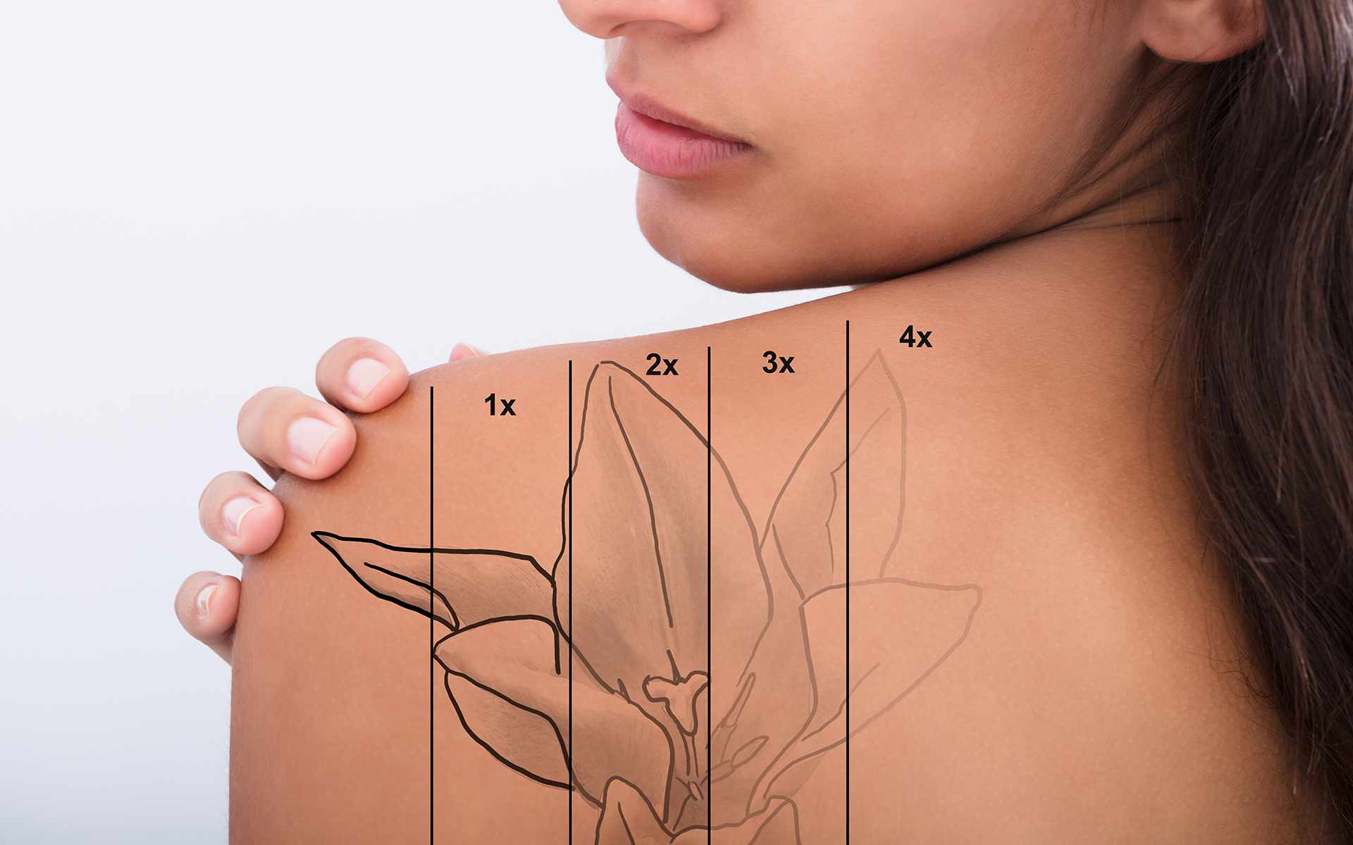 Tattoo entfernen Methoden Tattooentfernung Hautentschleifung Blumentattoo Schulter