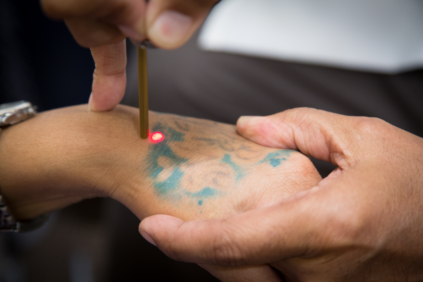 Tattoo entfernen Methoden Tattooentfernung Laser Dauer