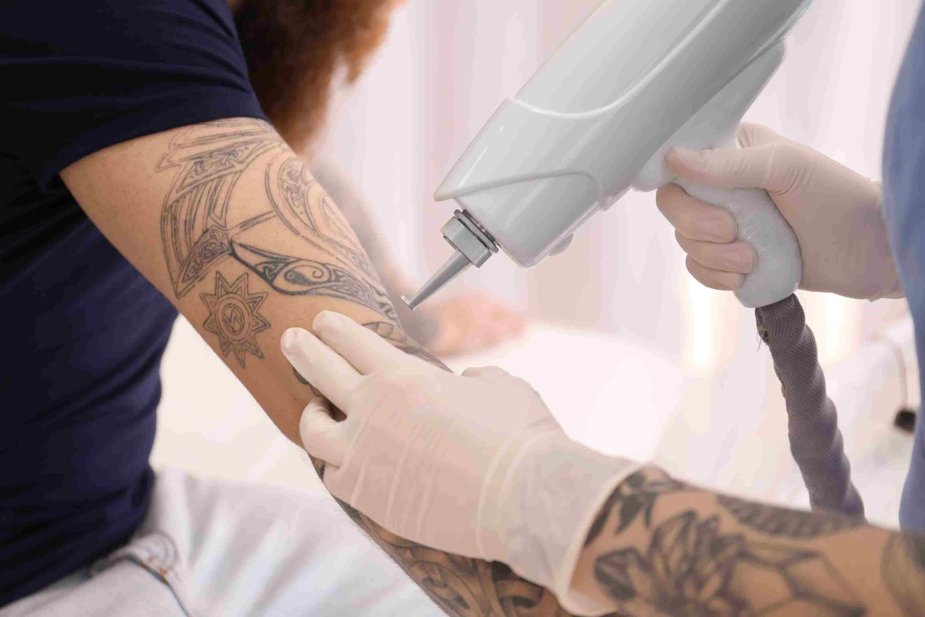 Tattoo entfernen Methoden Tattooentfernung Operation Erfahrungen