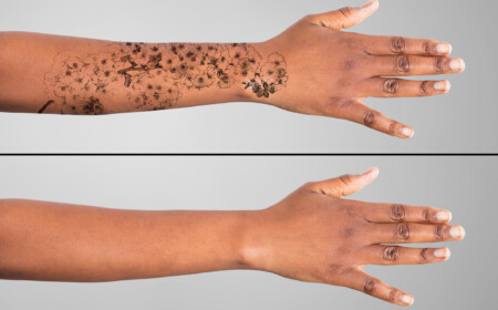Tattoo entfernen Methoden Tatooentfernung Peeling Handtattoo Blumen