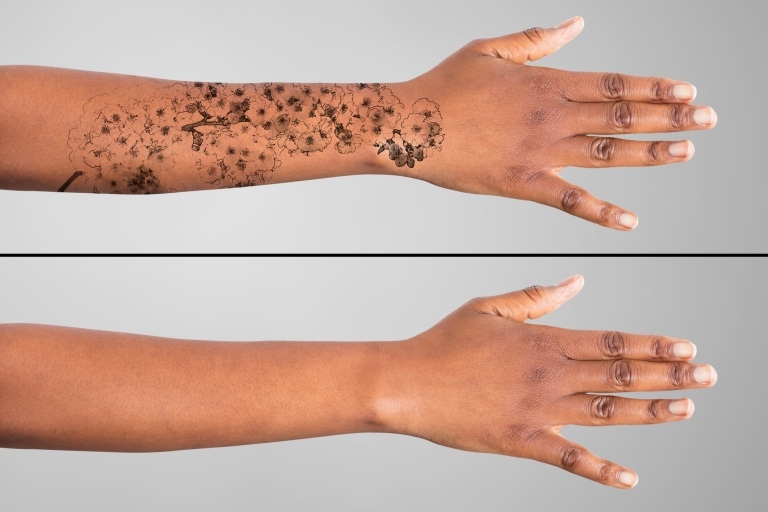 Tattoo entfernen Methoden Tatooentfernung Peeling Handtattoo Blumen