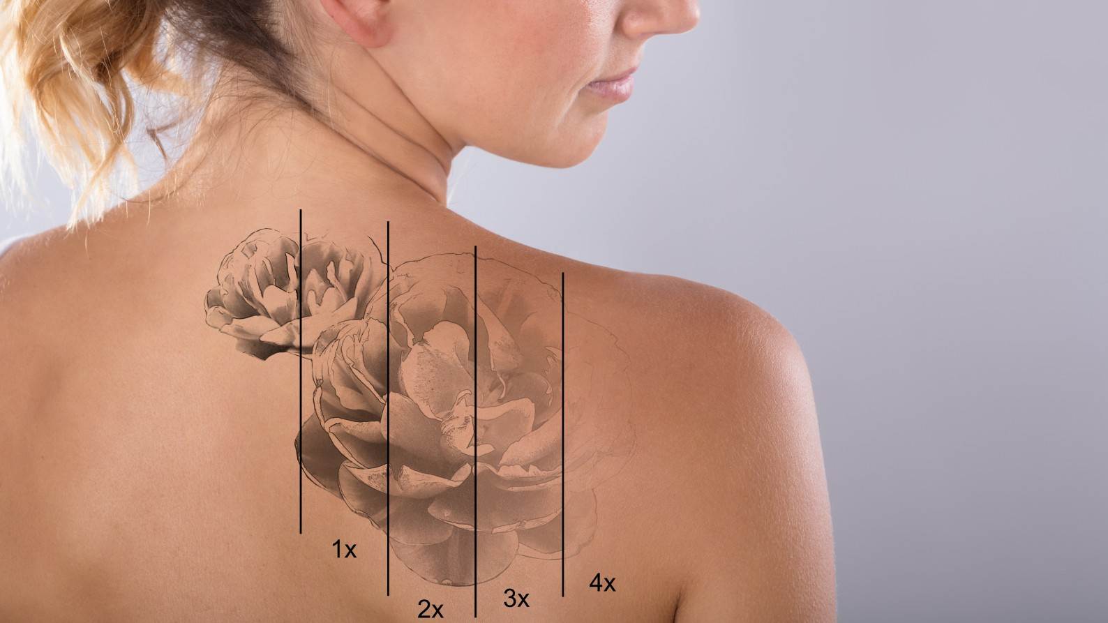 Tattoo entfernen lassen Laser Tattooentfernung Dauer Schmerzen