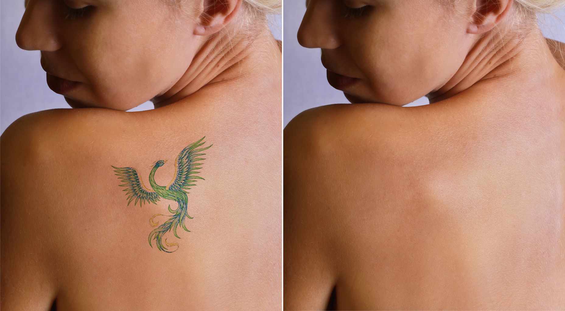 Tattooentfernung Methoden Phoenix Tattoo Schulter Frauentattoo Trends