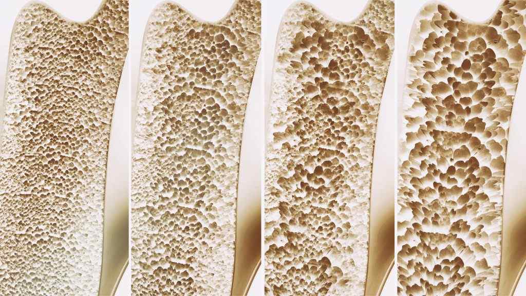 Studie zeigt Zusammenhang zwischen Triclosan und Osteoporose
