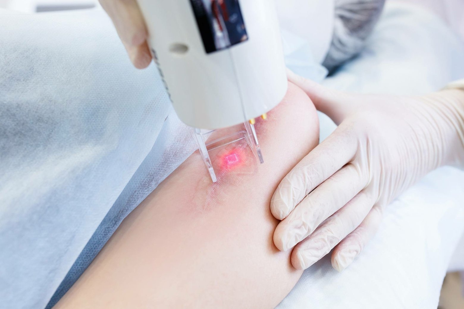 Dehnungsstreifen entfernen Laserbehandlung Hautpflege Kosten Narben entfernen Methoden