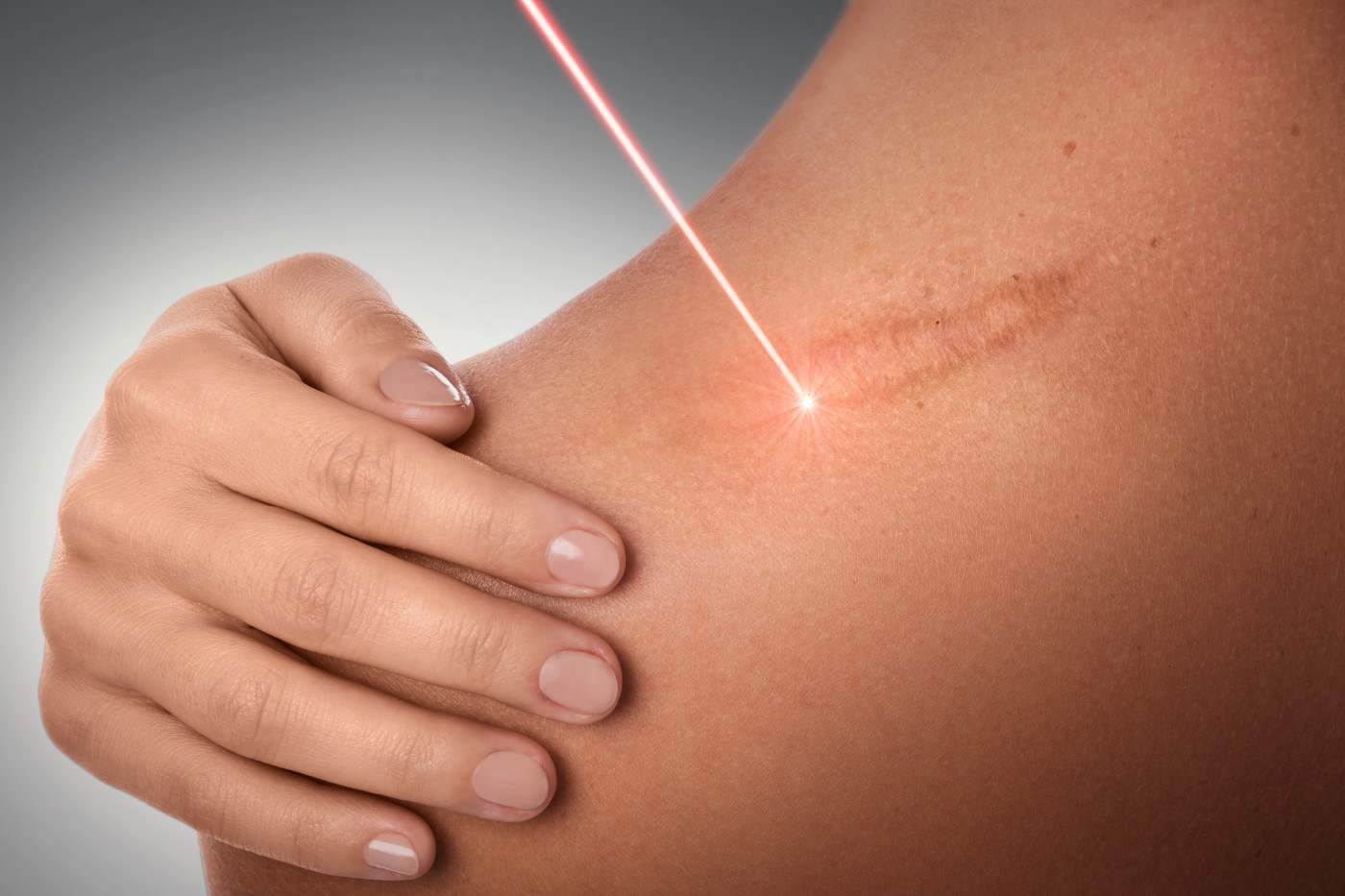 Dehnungsstreifen entfernen Lasern Kosten Dauer Hautpflege Schwangerschaft abnehmen