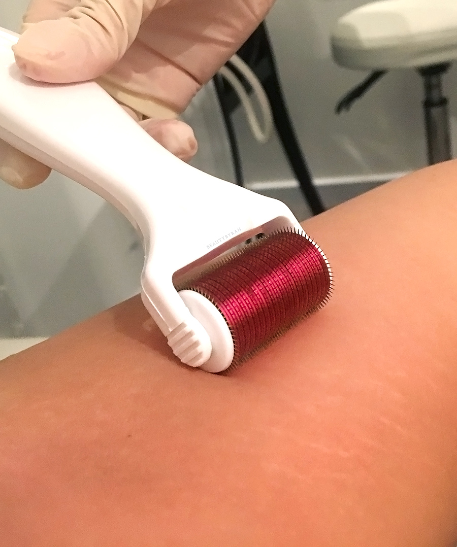 Dehnungsstreifen entfernen Methoden Micro Needling Erfahrungen Hautpflege Sommer
