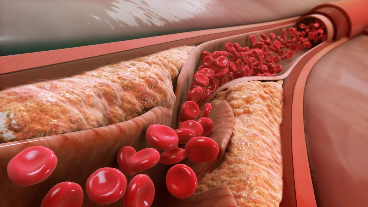 Blood fat values ​​consist of cholesterol and triglycerides, as well as other blood values