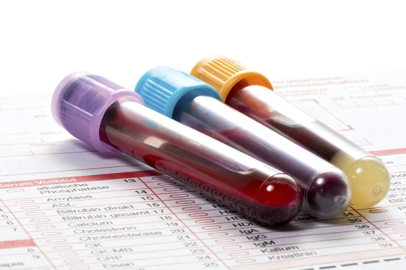 Blood values ​​in the blood picture are used to diagnose various diseases