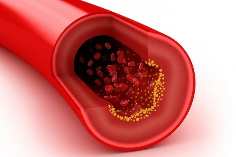 Cholesterol-Werte werden ermittelt, um das Risiko für Infakrte zu senken