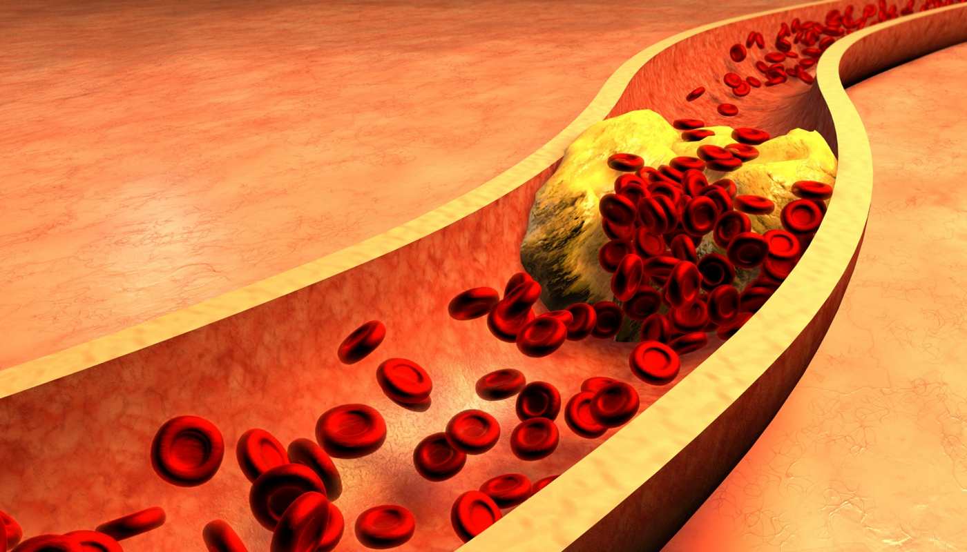 LDL cholesterol is bad, as it can lead to heart attack and stroke