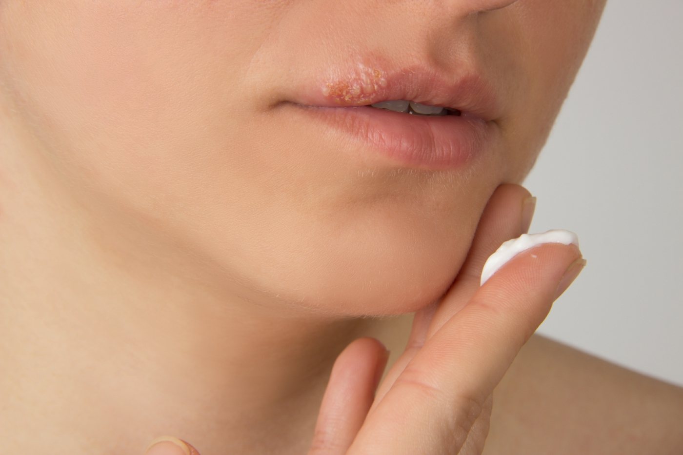 Creams and ointments from the pharmacy in battle against lip herpes reduce the duration of the disease