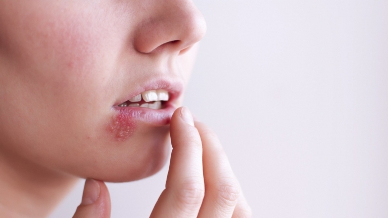 Fieberbläschen bei Lippenherpes sind ansteckend und dürfen nicht aufgeplatzt werden