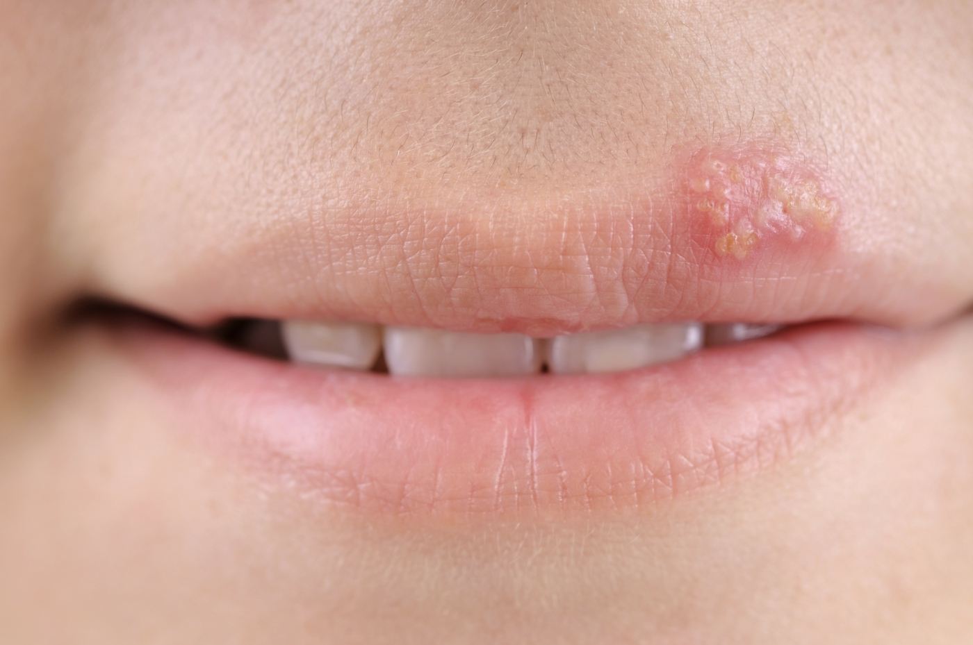 Typical for lip herpes and other herpes types are the small blisters on the skin