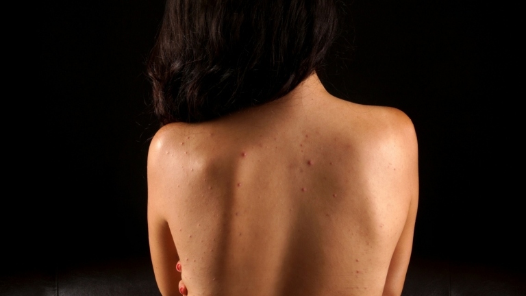 Akne auf dem Rücken ist unangenehm, aber wie kann man sie verhindern