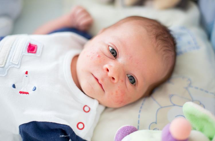Ausschlag bei Kindern und Babys und rote Flecken im Gesicht sollten vom Arzt untersucht werden