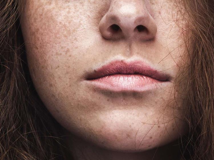 Rote Flecken im Gesicht - Wann entstehen Sie rund um Mund und Kinn