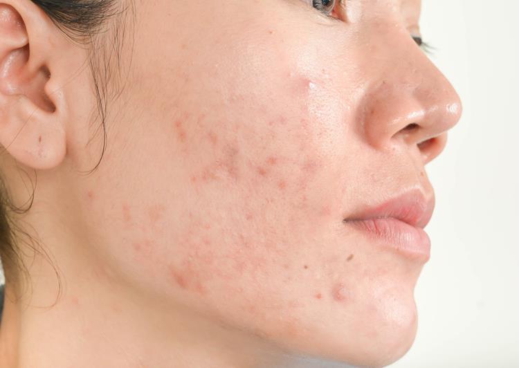 Ursachen für rote Flecken im Gesicht durch Akne sind unter anderem Hormonumstellungen