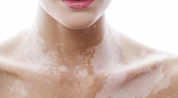 Weiße Flecken auf gebräunter Haut sind eine Pigmentstörung