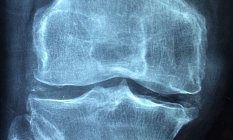 raum zwischen knochen gelenkerkrankung und rheumatoide arthritis diagnostizieren