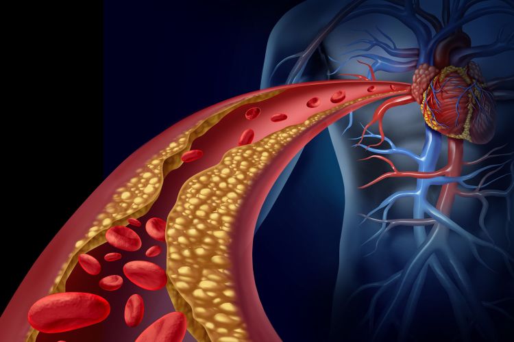 cholesterin blutbahn körper herzprobleme studie