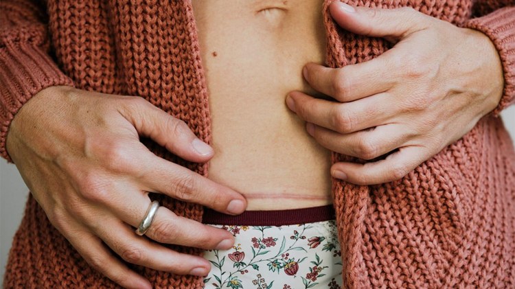 Narben beim Kaiserschnitt unsichtbar machen und Wundheilung fördern Tipps