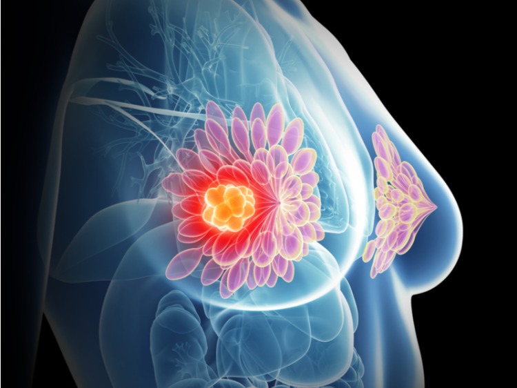 brustkrebs untersuchen entzündungshemmende medikamente wirkung