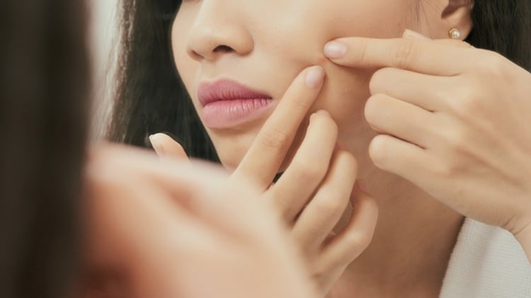 Ringelblumencreme gegen Pickel, Akne und Mitesser verwenden für ein schönes Hautbild
