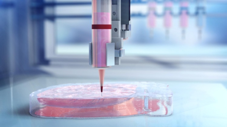 bioprinting verfahren ersetzt hauttransplantation bei schweren verbrennungen