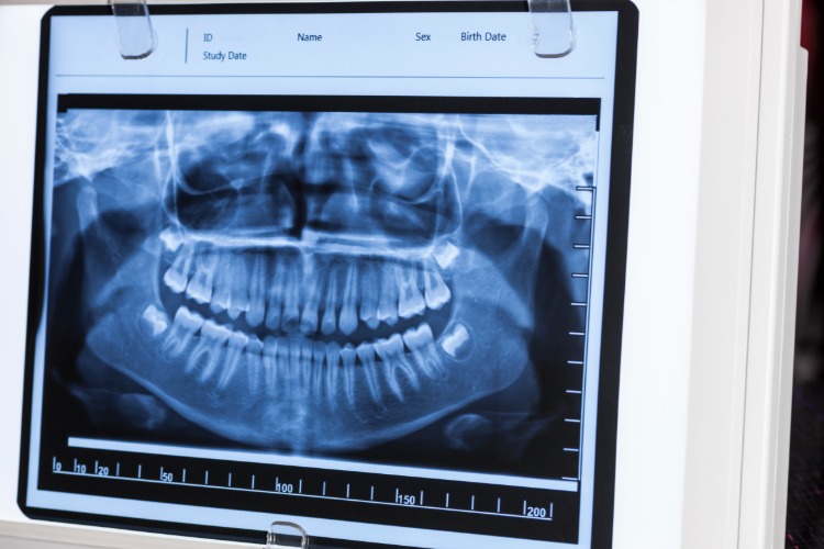 röntgenbild von zähnen mit diagnose vom zahnarzt
