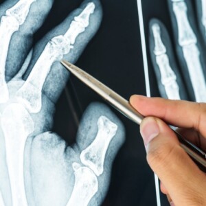 röntgenbild handgelenk osteoporose