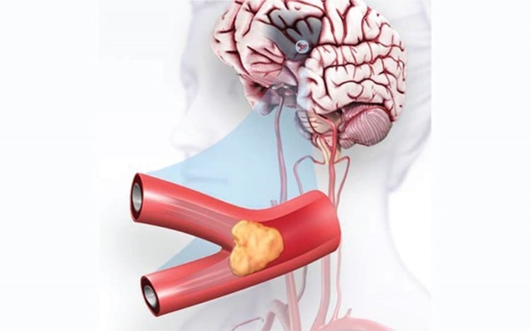 ischemic stroke prevent clogging of the artery leading to the brain