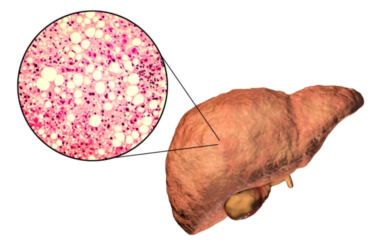 Non-alcoholic liver disease can be prevented by eating a high protein diet