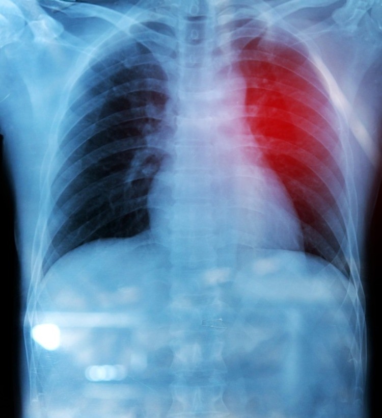 x-ray of lungs with red zone of diaphragm