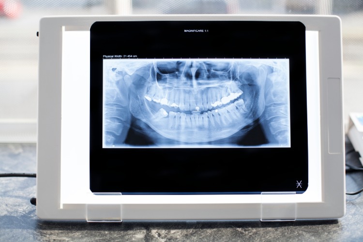 X-ray image of teeth on a screen in dental office for examination