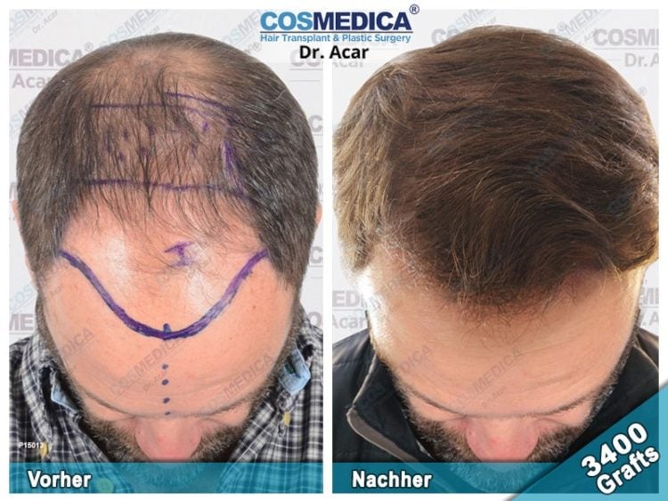 Haartransplantation Geheimratsecken von Dr Acar in Klinik in Türkei vorher nachher im Vergleich
