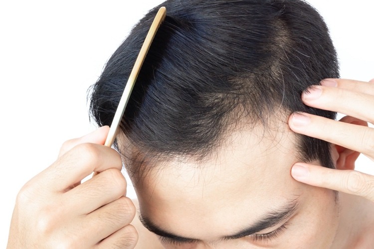 Bei Neo Fue Haartransplantation ist die Anwachsrate der implantierten Haare höher